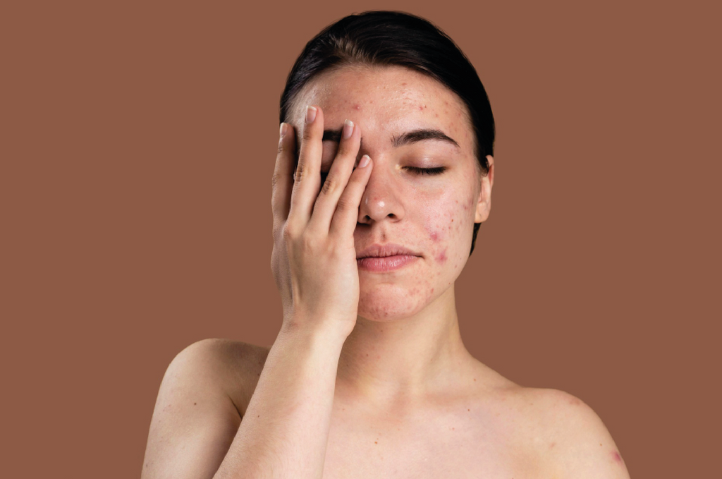Tratamiento y prevención de problemas de piel comunes: Consejos de expertos